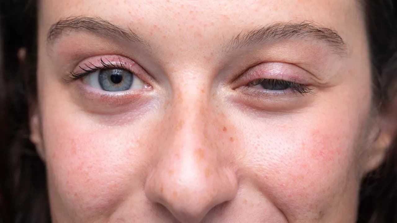 Opadająca powieka przyczyny – zaskakujące powody i skutki problemu