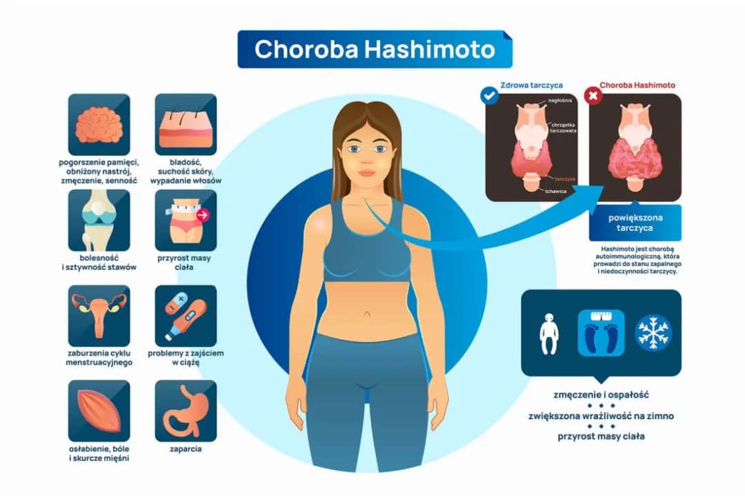 Wszystkie objawy choroby Hashimoto - kompletna lista symptomów