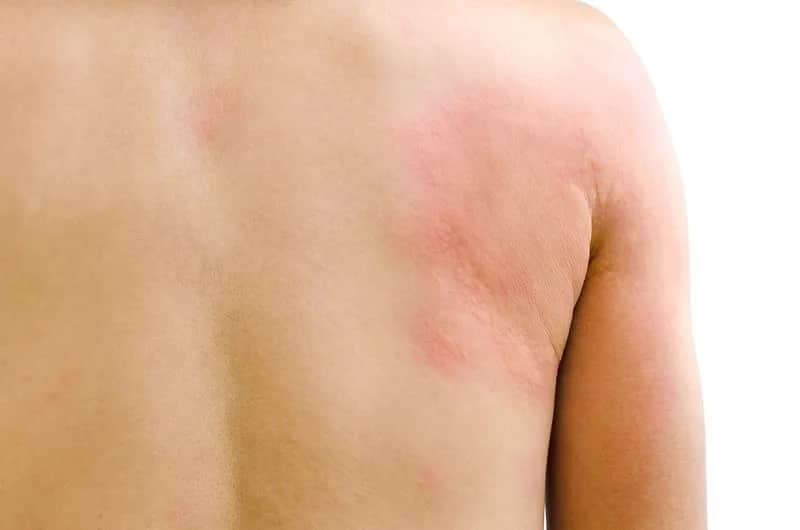 Objawy tocznia rumieniowatego: poznaj pierwsze niepokojące symptomy choroby