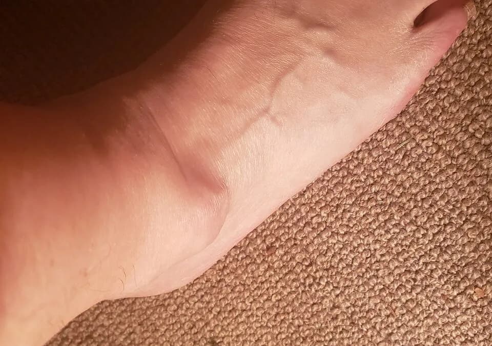 Zgrubienie po siniaku: Przyczyny, objawy i skuteczne leczenie