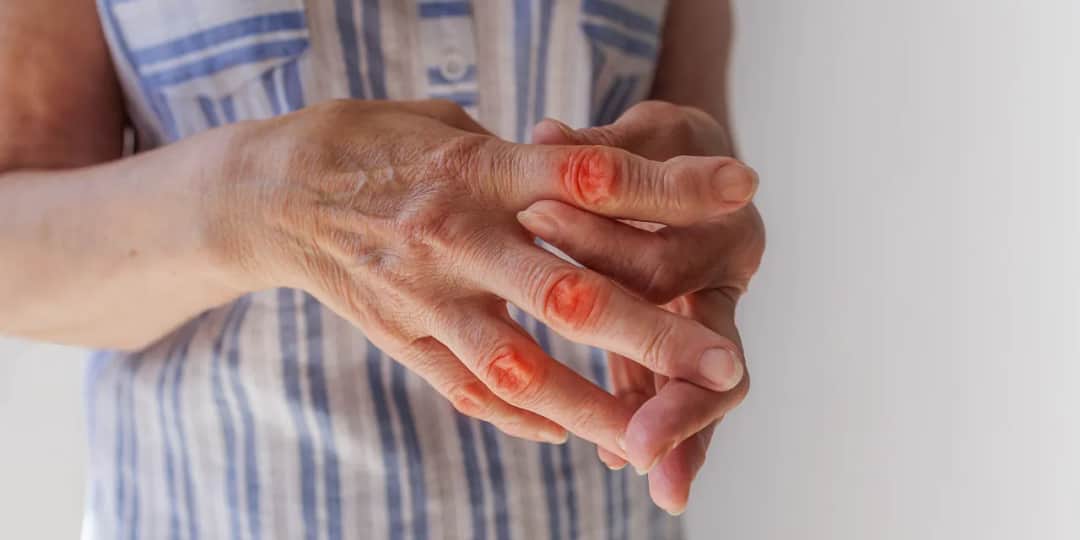 Wszystkie objawy rzs - poznaj pierwsze oznaki tej poważnej choroby