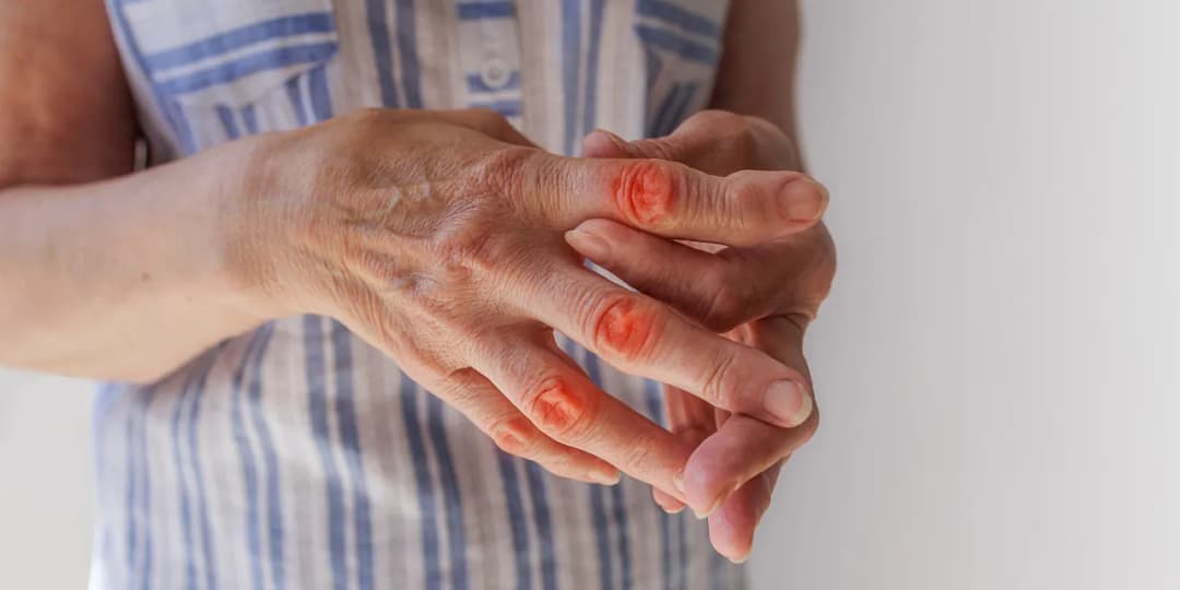 Wszystkie objawy rzs - poznaj pierwsze oznaki tej poważnej choroby