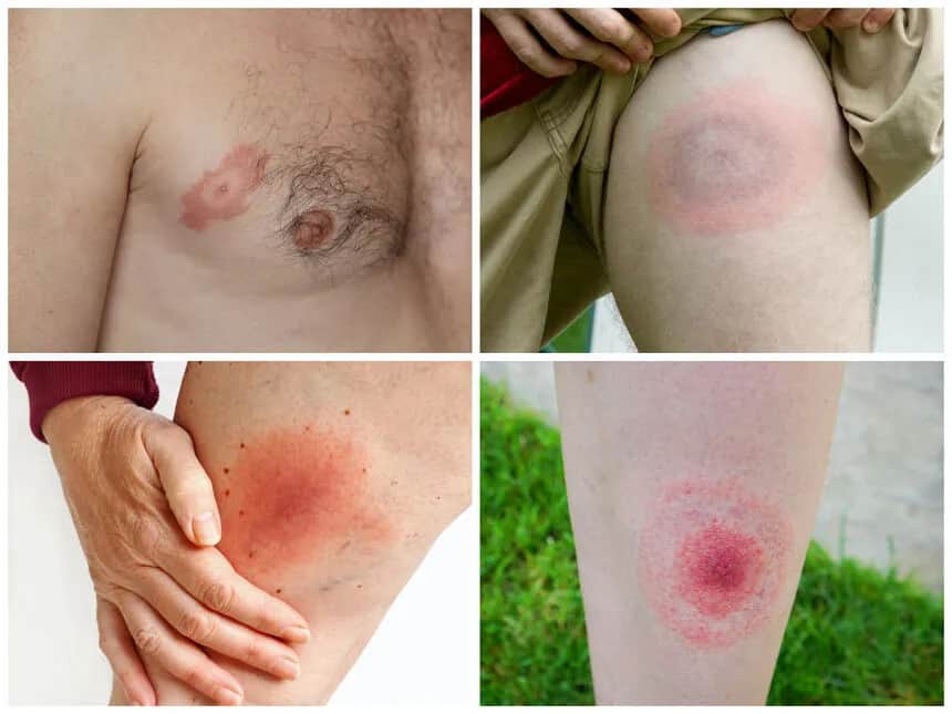 Jakie są objawy boreliozy - rozpoznaj groźną chorobę z Lyme wcześnie