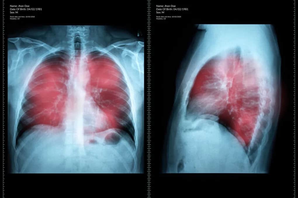 Najważniejsze objawy raka płuc: pierwsze niepokojące sygnały choroby