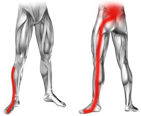 Jakie są objawy rwy kulszowej - kompletne zestawienie dolegliwości