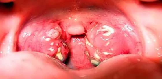 Angina przyczyny - co wywołuje tę bolesną chorobę gardła?