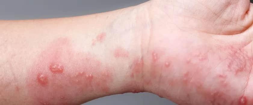 Świerzb objawy - rozpoznaj pierwsze oznaki choroby u siebie i bliskich