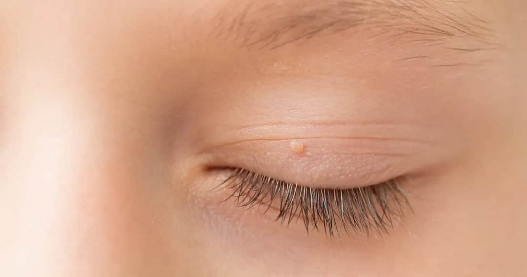 Jak wygląda brodawczak? Rozpoznaj zmiany skórne bez pomyłek