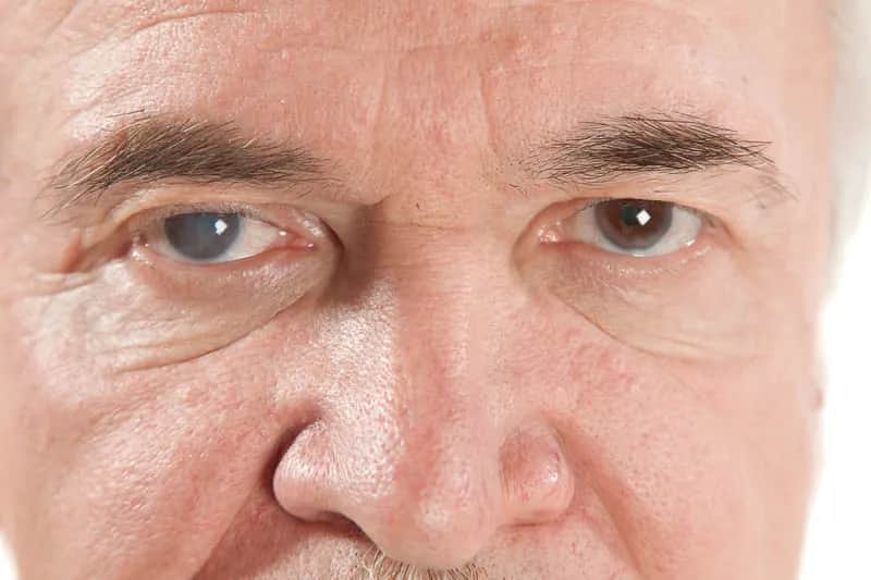 Najważniejsze objawy jaskry - poznaj oznaki tej groźnej choroby oczu