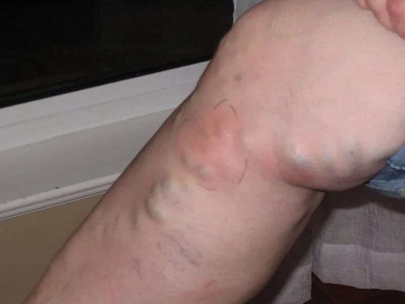 Jak zapobiec zakrzepicy i uniknąć poważnych konsekwencji zdrowotnych