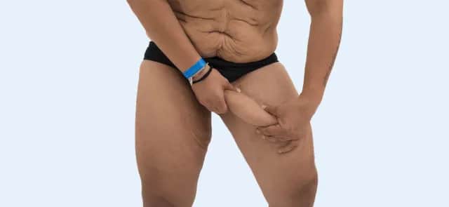 Jak skutecznie naciągnąć skórę po odchudzaniu - sprawdzone sposoby napinania