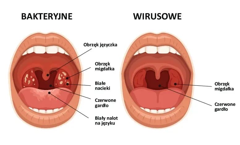 Jakie są objawy anginy bakteryjnej i wirusowej? Charakterystyczne oznaki