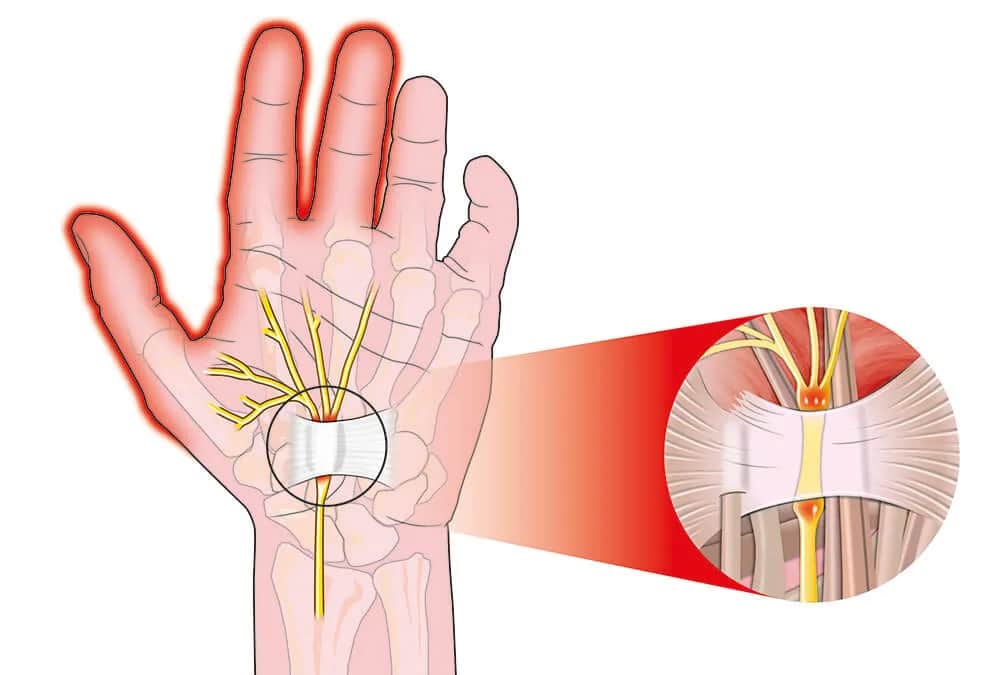 Naciągnięte ścięgno ręki: 7 objawów, które nie mogą Cię zmylić