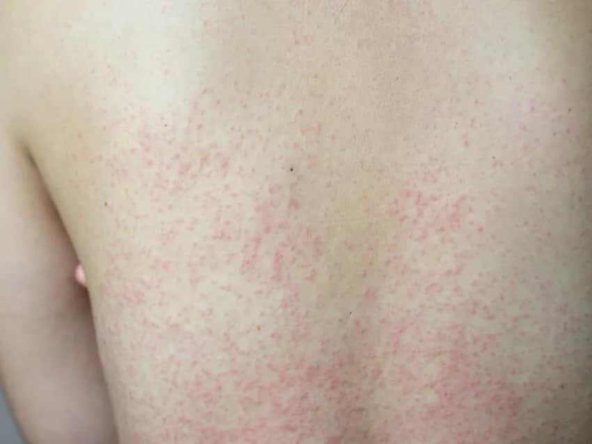 Kiedy rozpoznać objawy różyczki - kompletna lista symptomów choroby