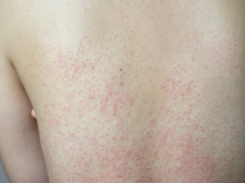 Kiedy rozpoznać objawy różyczki - kompletna lista symptomów choroby
