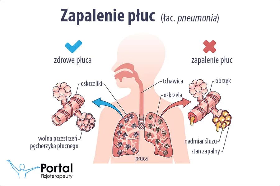 7 najgroźniejszych objawów zapalenia płuc, które musisz rozpoznać szybko