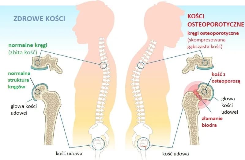 Objawy osteoporozy: jak je rozpoznać i kiedy udać się do lekarza