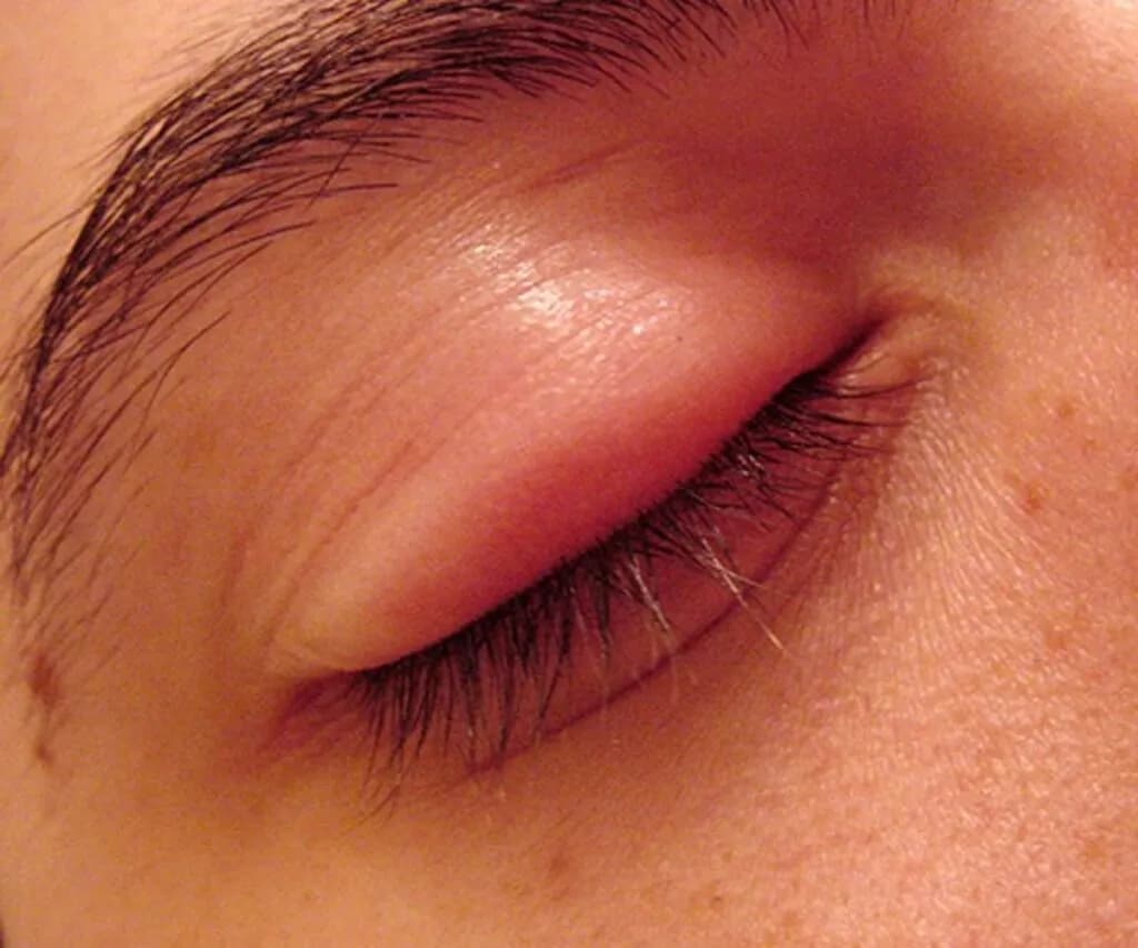 Obrzęk jednej powieki górnej: najważniejsze przyczyny i objawy, które musisz znać