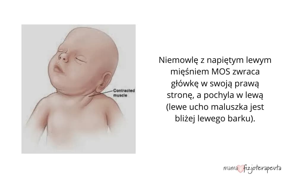 Rozpoznaj naciągnięcie mięśni karku u niemowlaka: najważniejsze objawy