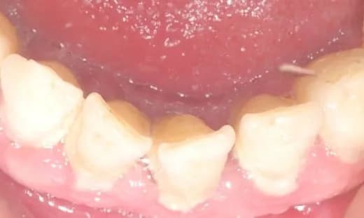 Czy usuwanie kamienia nazębnego jest na NFZ? Sprawdź, co refunduje fundusz