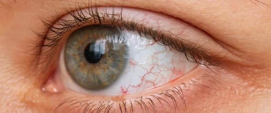 Przekrwione oczy przyczyny – jakie mogą być poważne skutki?