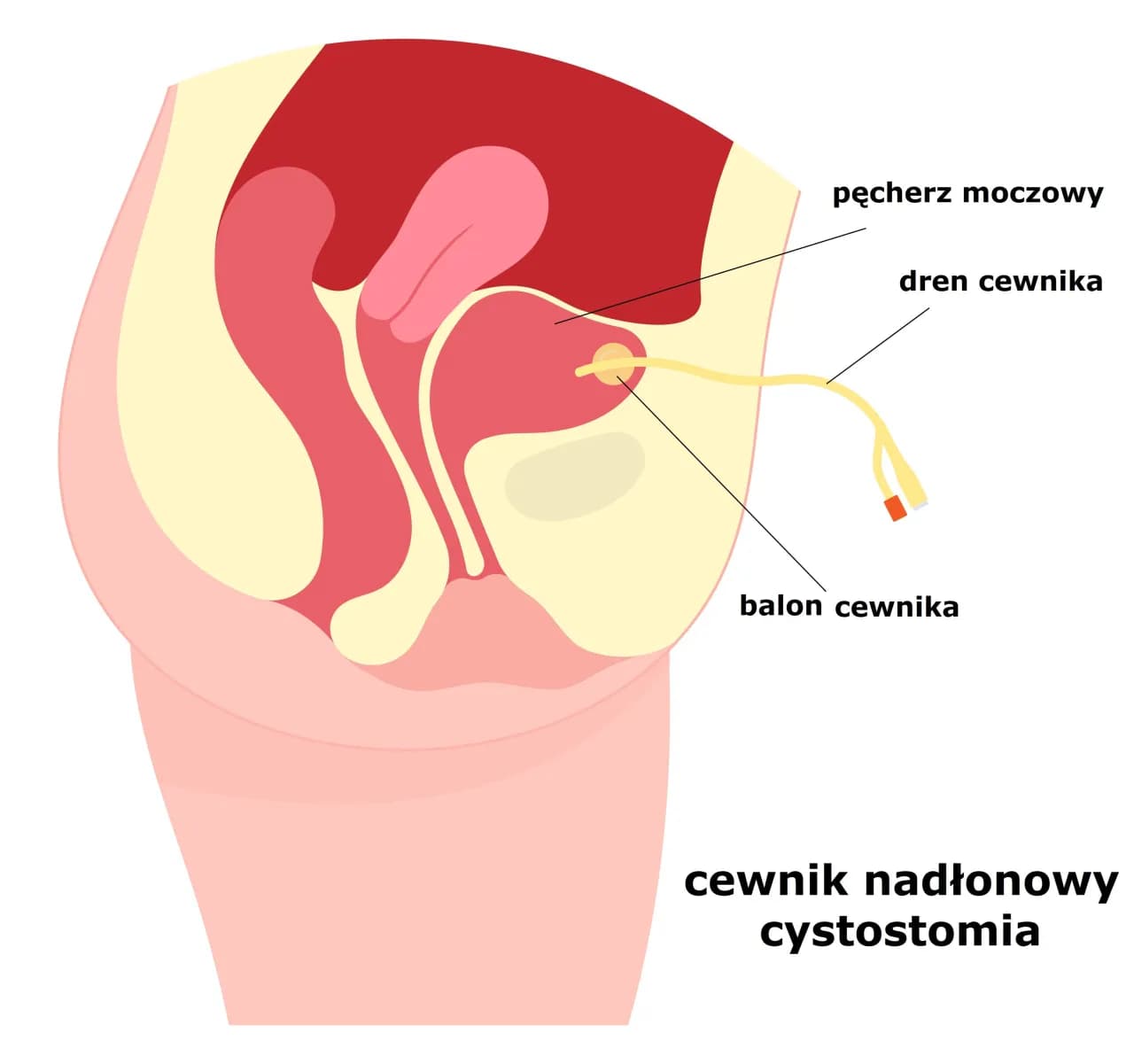 Zatrzymanie moczu po cewnikowaniu: przyczyny i postępowanie