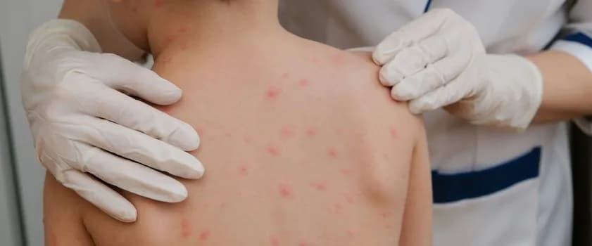 Jak zapobiec ospie po kontakcie z chorym i uniknąć poważnych konsekwencji