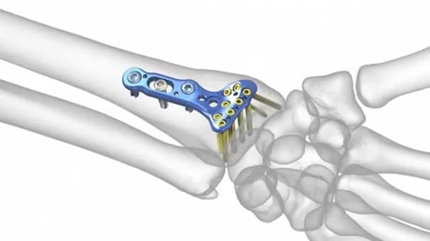 Ile trwa rehabilitacja po złamaniu nadgarstka? Kluczowe informacje o czasie powrotu do zdrowia