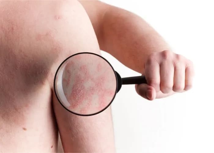 Wszystkie objawy kiły - rozpoznaj chorobę zanim będzie za późno