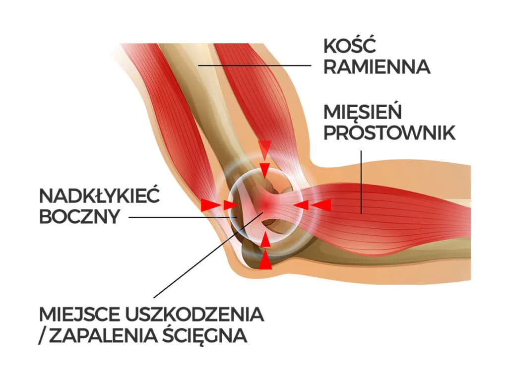 Objawy łokcia tenisisty: 5 kluczowych symptomów do rozpoznania