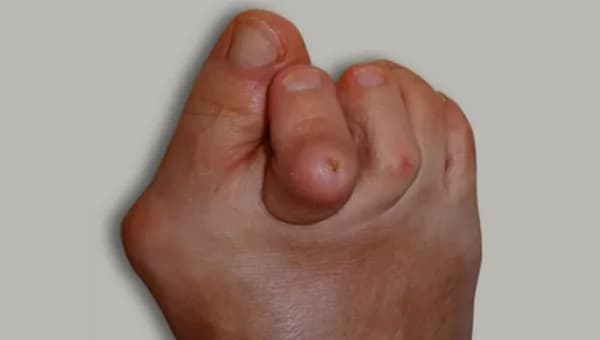 Opuchnięte i zaczerwienione palce u nóg: przyczyny i leczenie