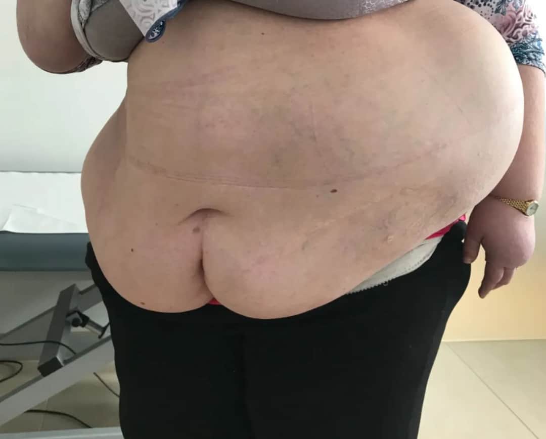 Przepuklina brzuszna u dorosłych - 7 niepokojących objawów