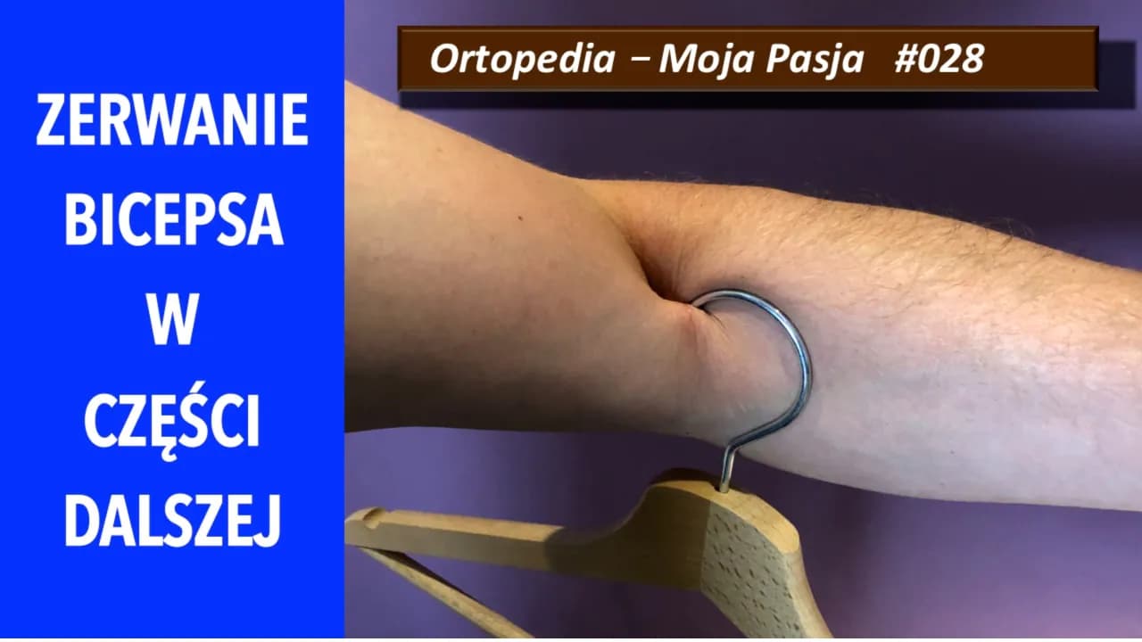 Naderwany biceps - objawy, które powinny cię zaniepokoić