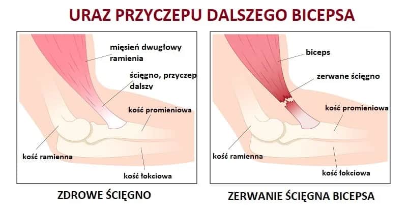 Naderwany biceps - objawy, które powinny cię zaniepokoić