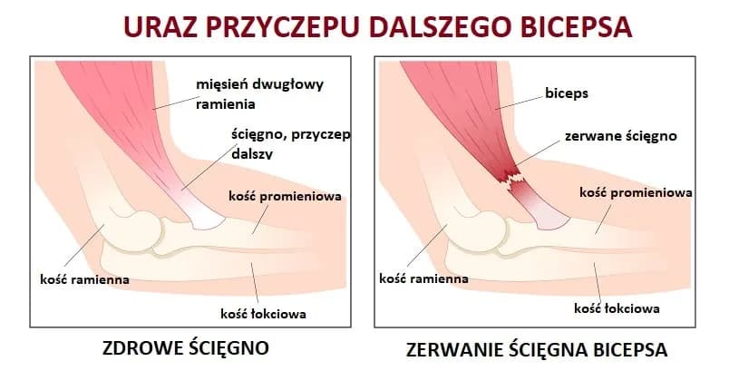 Naderwany biceps - objawy, które powinny cię zaniepokoić