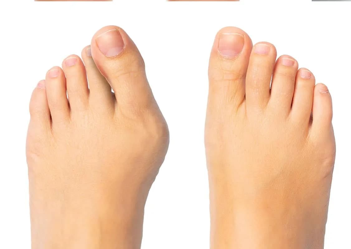 Zrośnięte palce u stóp: przyczyny, rodzaje i metody leczenia