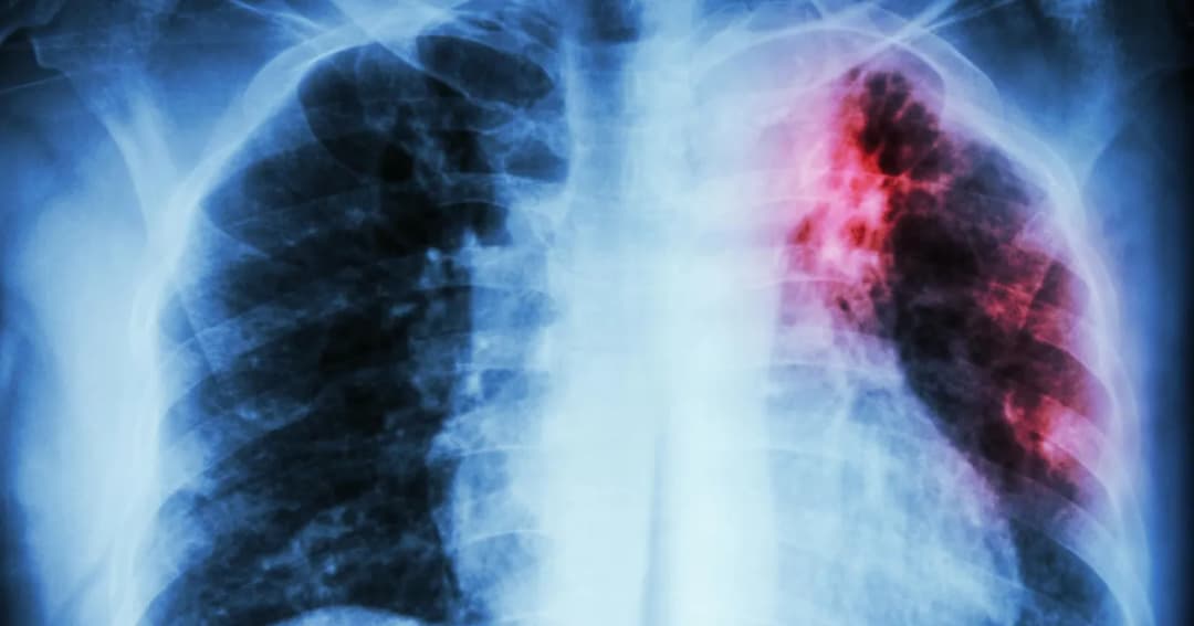 Jakie są objawy gruźlicy? Poznaj wszystkie sygnały ostrzegawcze choroby