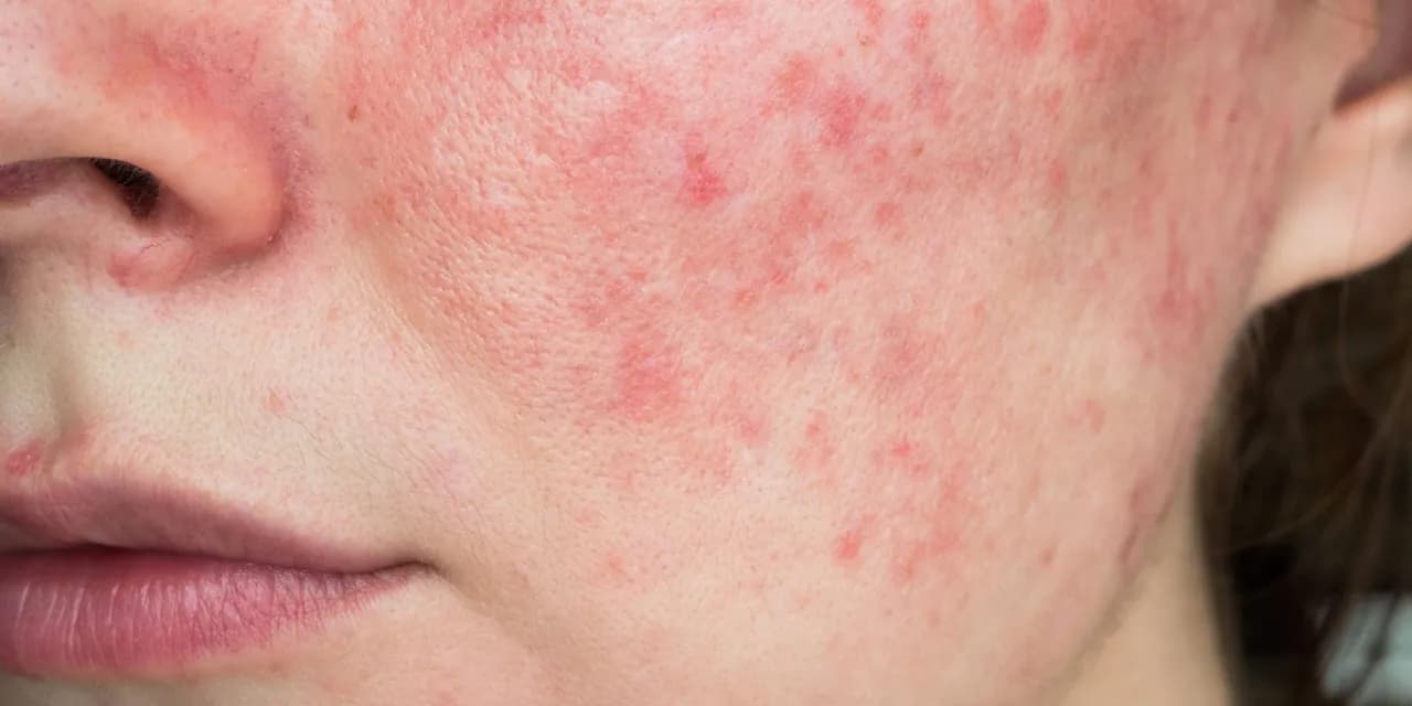 Trądzik różowaty przyczyny: poznaj najważniejsze czynniki i ryzyko