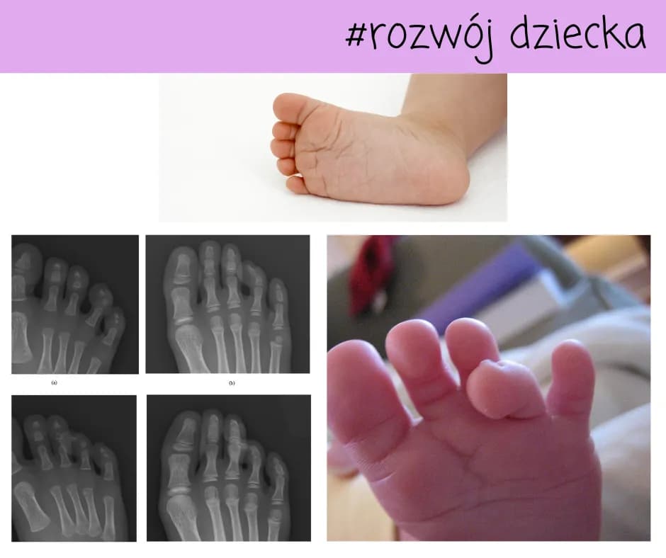 Krzywe palce u nóg dziecka - przyczyny i skuteczne leczenie