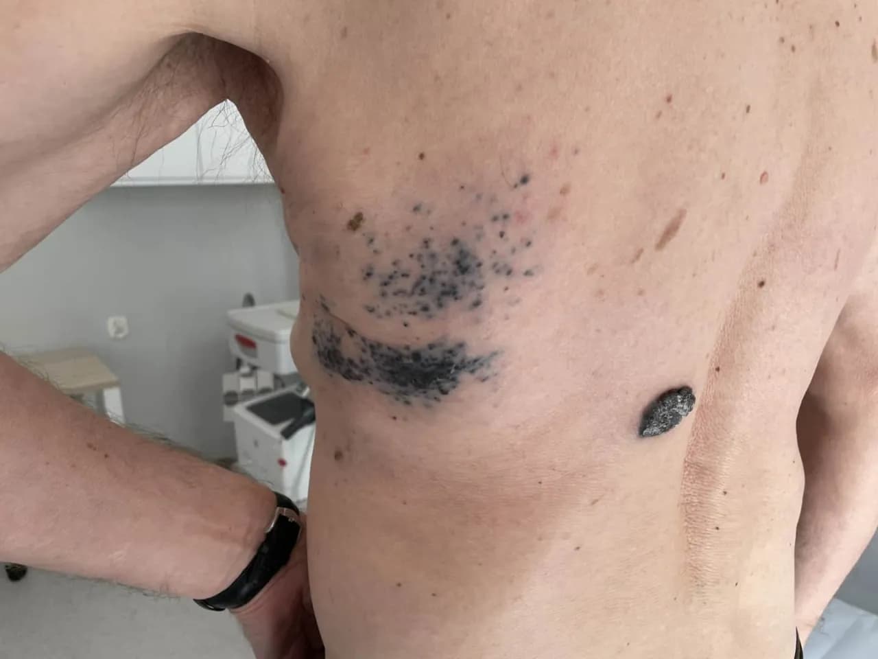 Niepokojące objawy czerniaka - poznaj pierwsze sygnały ostrzegawcze skóry