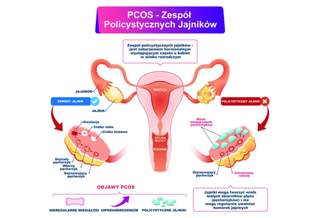 PCOS i objawy, które musisz znać: kompletna lista objawów choroby