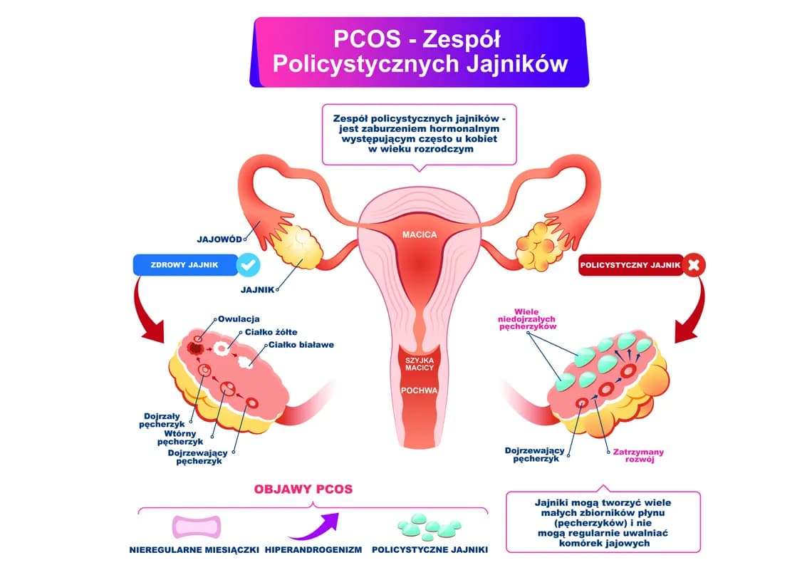 PCOS i objawy, które musisz znać: kompletna lista objawów choroby