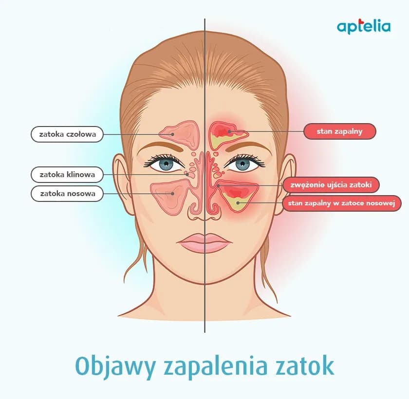 Najczęstsze objawy zapalenia zatok: 10 niepokojących sygnałów choroby