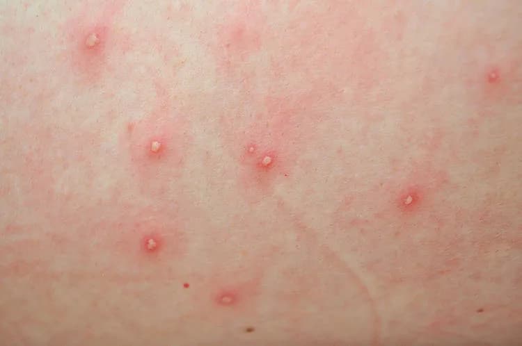 Objawy ospy wietrznej: jak je rozpoznać i uniknąć powikłań