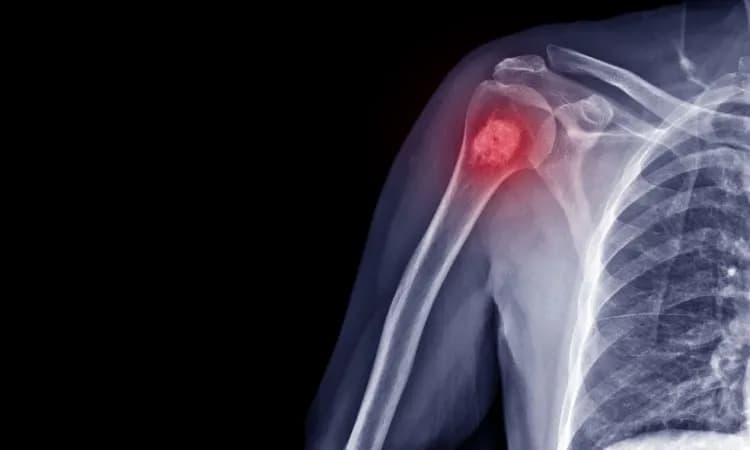 Najczęstsze objawy raka kości - co powinno Cię zaniepokoić i kiedy do lekarza