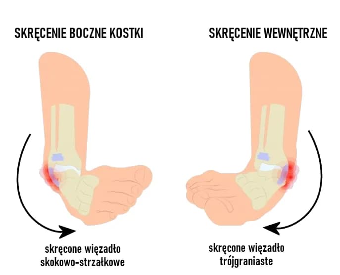 Czym się różni zwichnięcie od skręcenia? Prawda, która Cię zaskoczy