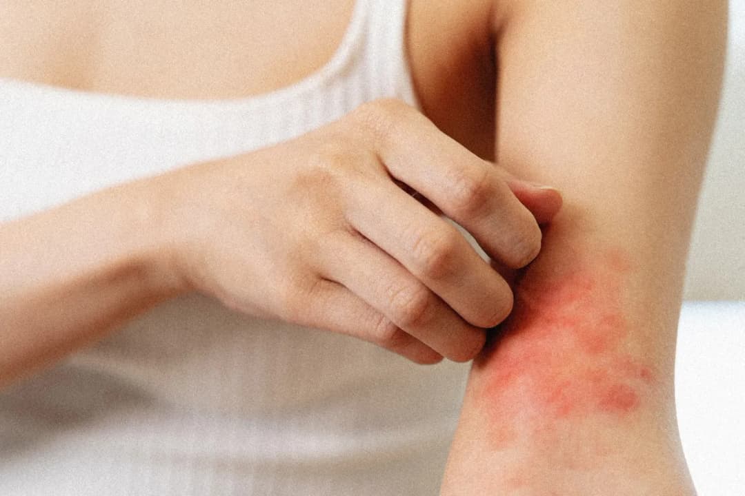 Paciorkowiec: wszystkie objawy oraz pierwsze sygnały zakażenia