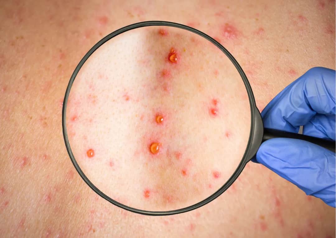 Pierwsze objawy ospy wietrznej: rozpoznaj chorobę na wczesnym etapie