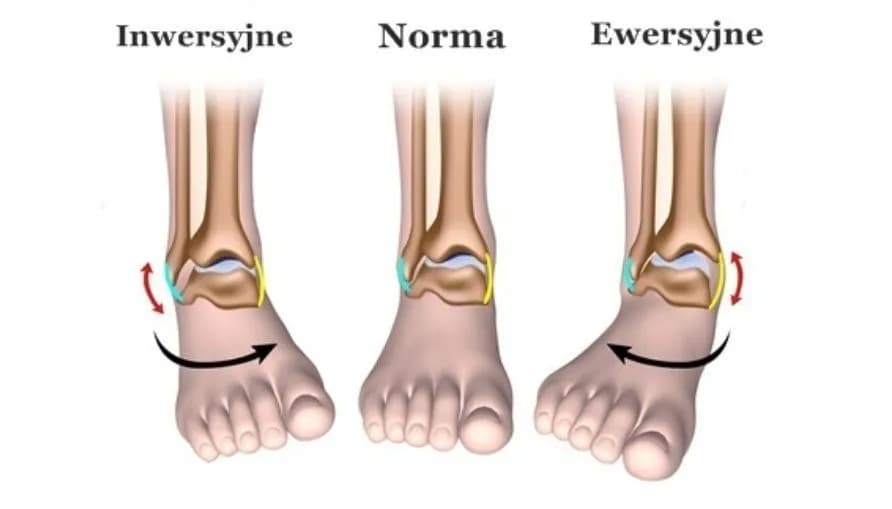 Co to skręcenie? Objawy, rodzaje i pierwsza pomoc przy urazie