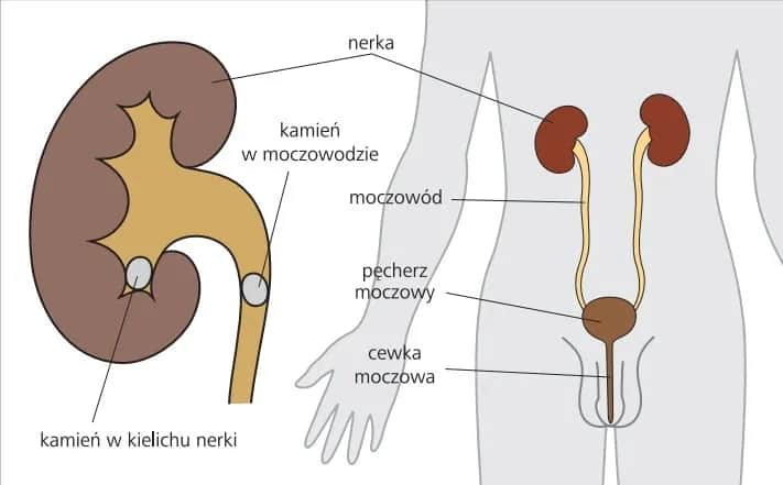 Objawy kamicy nerkowej - rozpoznaj niepokojące sygnały już dziś